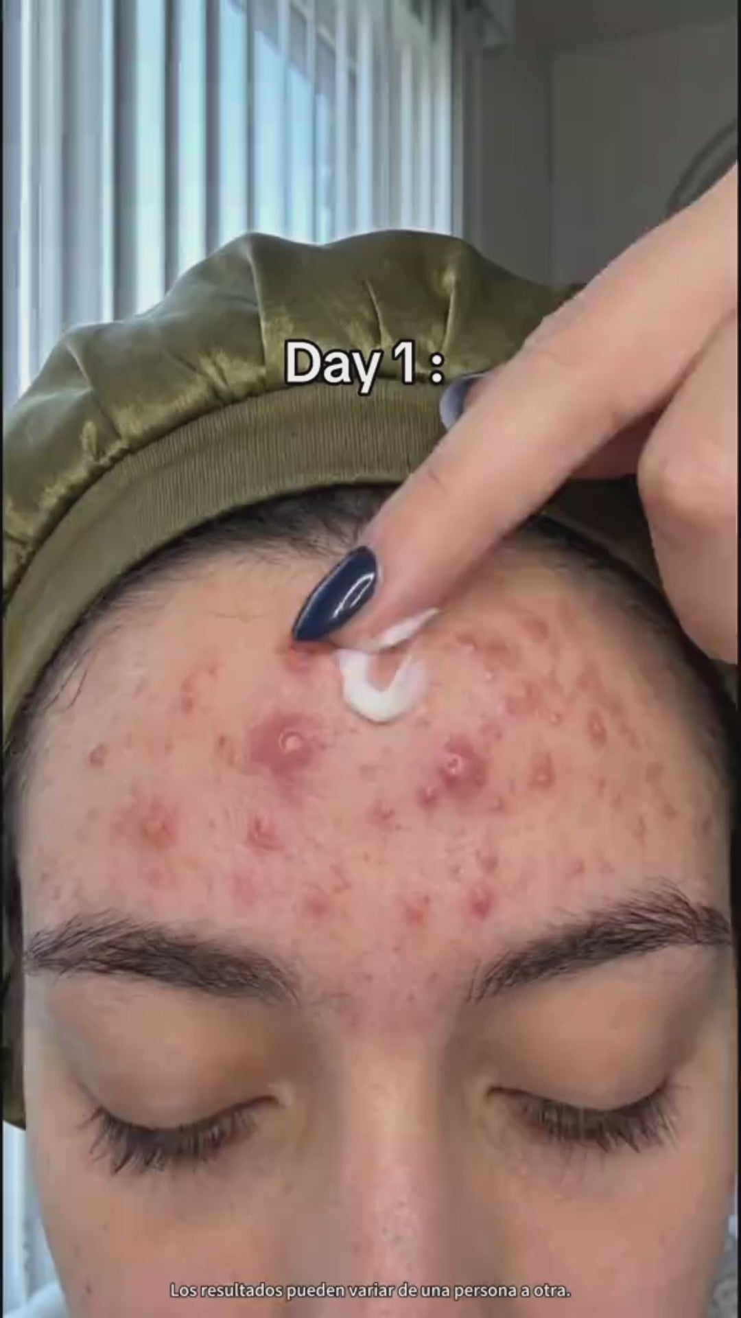 Crema Anti Acné Poros Cicatrices Piel Gr